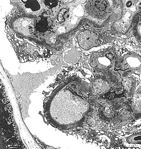 AJKD Atlas of Renal Pathology: Membranous .